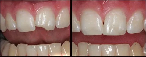 teeth with and without dental bonding