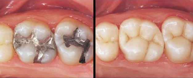 teeth with and without composite fillings