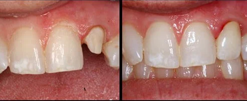 teeth with and without a crown
