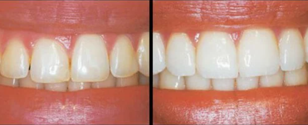 image with and without gum reshaping