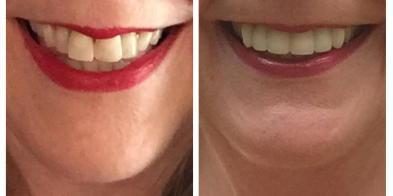 Smile Before & After 8